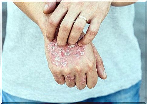 Herbal therapies for psoriasis - learn about the 5 most effective