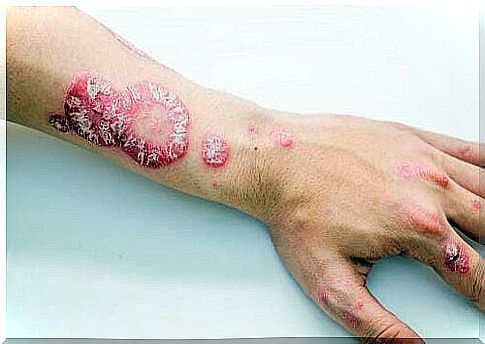 Psoriasis on the hands.