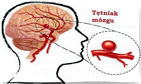 Aneurysms - how to detect them and how to prevent them?