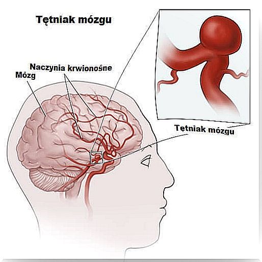 Diagram showing brain aneurysms developing