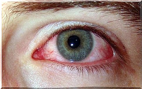 A severely red eye