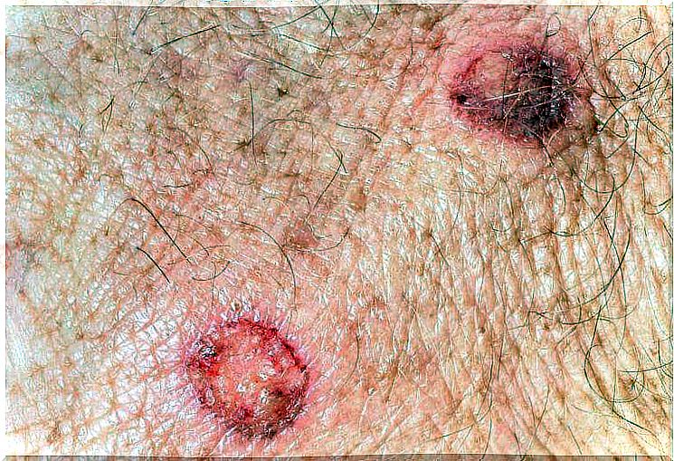 Neoplastic changes on the skin