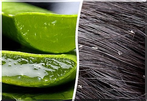 Dandruff - how to fight it with simple home remedies?