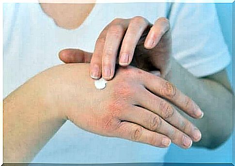 A woman lubricating dry and chapped hands with cream