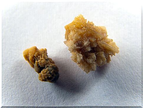 Kidney stones - how to prevent them?