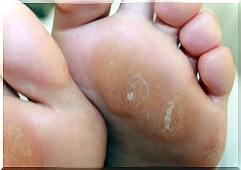 Calluses - Remove them with 4 home remedies