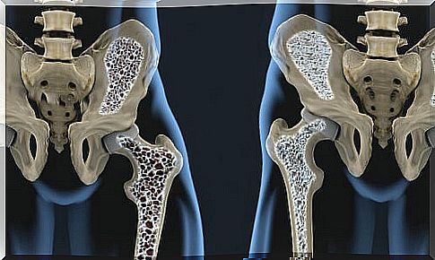 Reduced bone density in osteoporosis