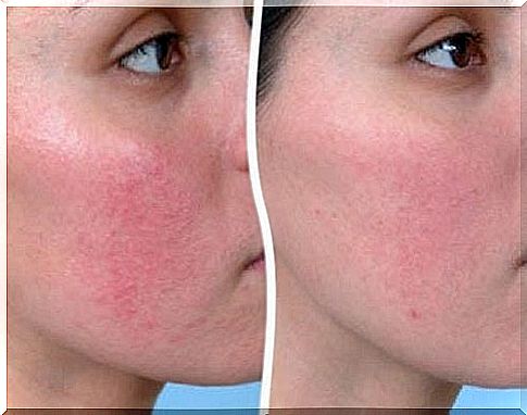 Rosacea - useful recommendations