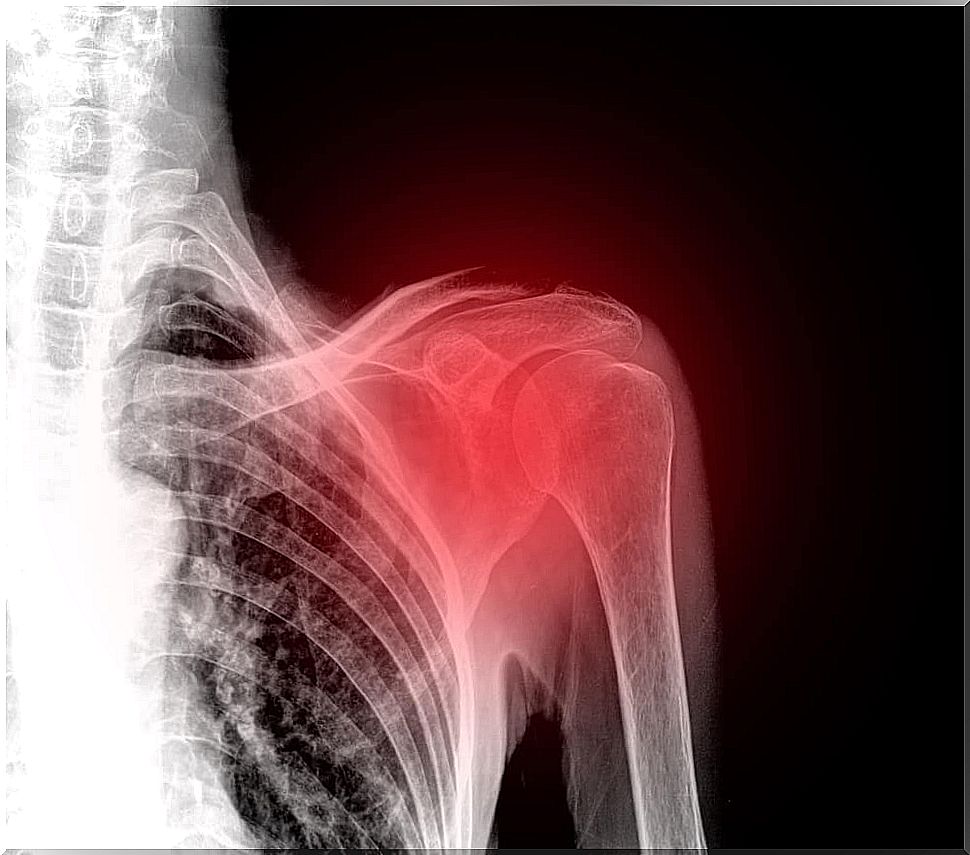 Shoulder pain - how to relieve it with home remedies