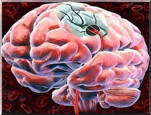 Stroke - How Do I Recognize the Symptoms?