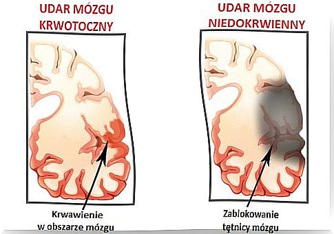 Stroke - symptoms and causes