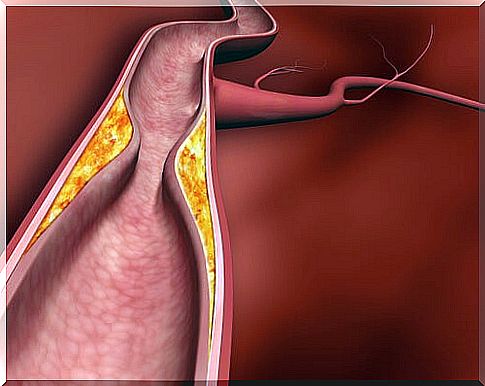 3 #: Atherosclerosis-cholesterol.jpg