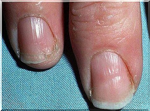 Split nails