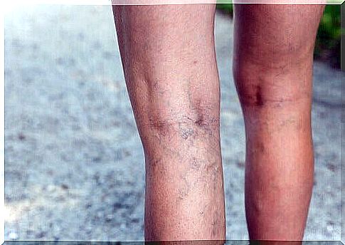 Varicose veins and tomatoes 