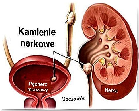 Kidney stones