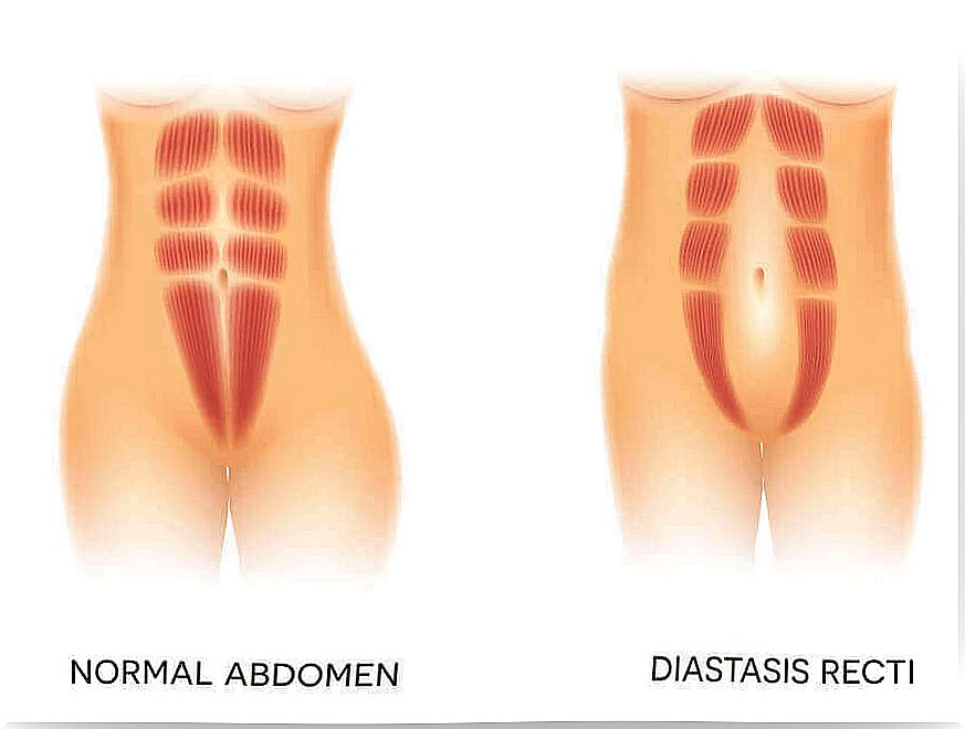 Rectus abdominis muscle dehiscence